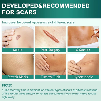 Silicone Scar Sheets for Al