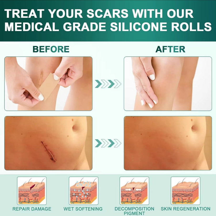 Silicone Scar Sheets for Al