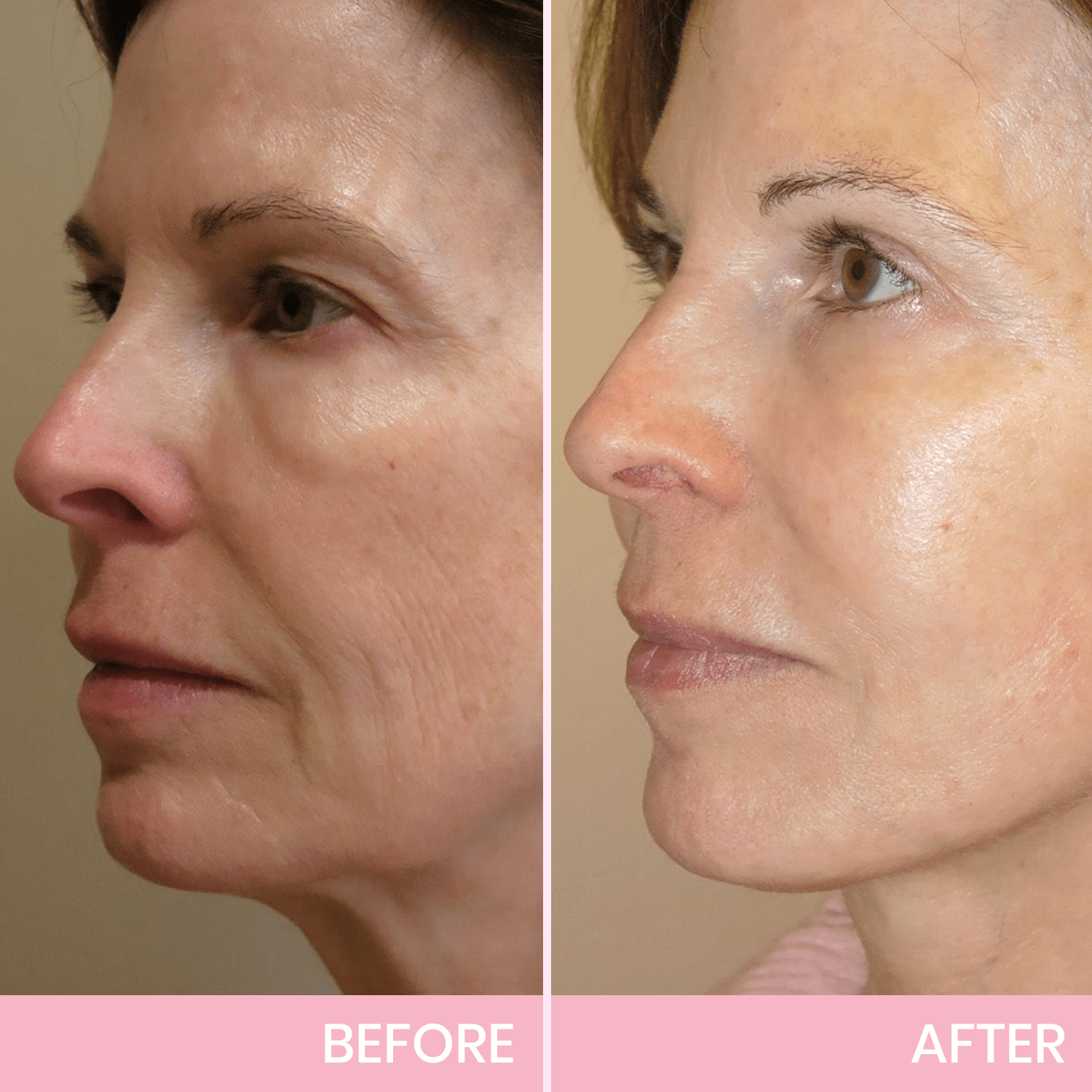 Luhaka™ V-Face Lifting Invisible Adhesive Tape 2