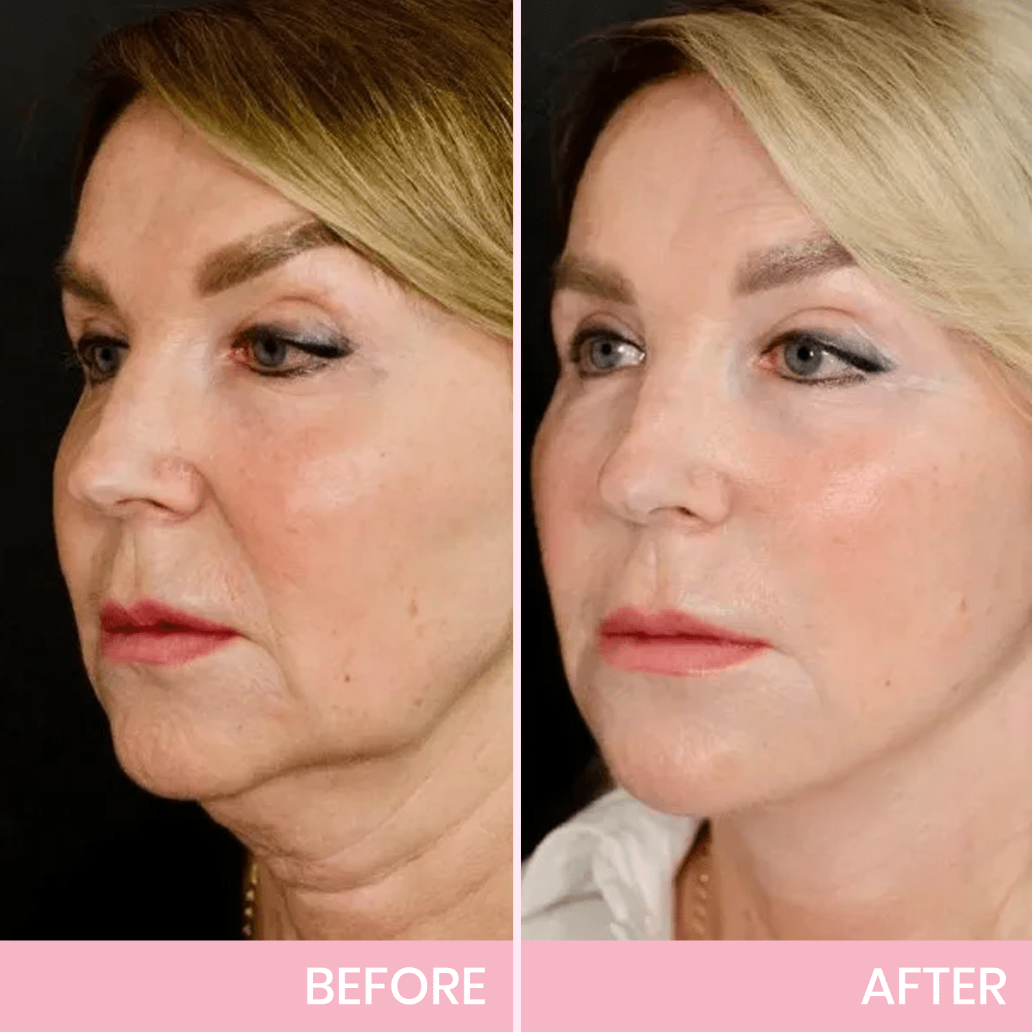 Luhaka™ V-Face Lifting Invisible Adhesive Tape 2