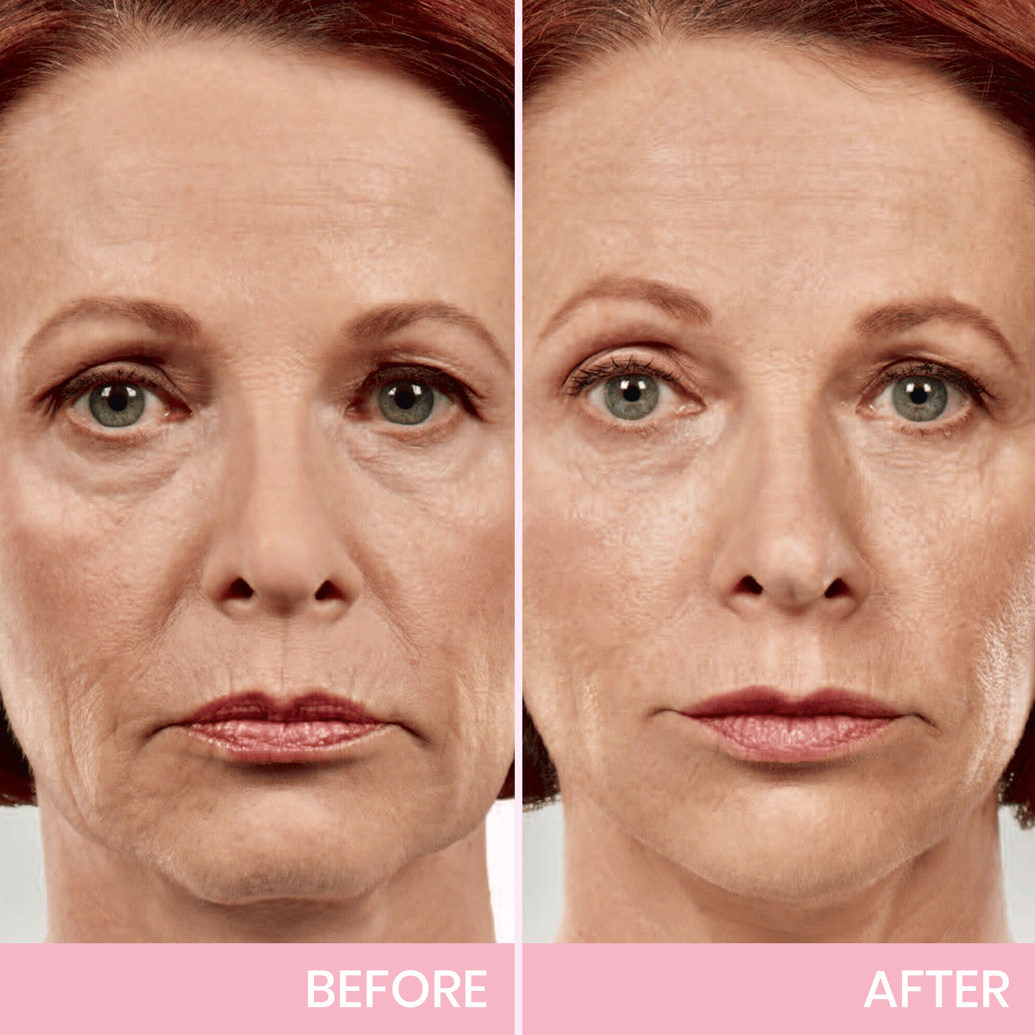 Luhaka™ V-Face Lifting Invisible Adhesive Tape 2